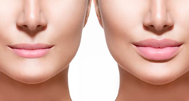 Dermal and Lip Fillers