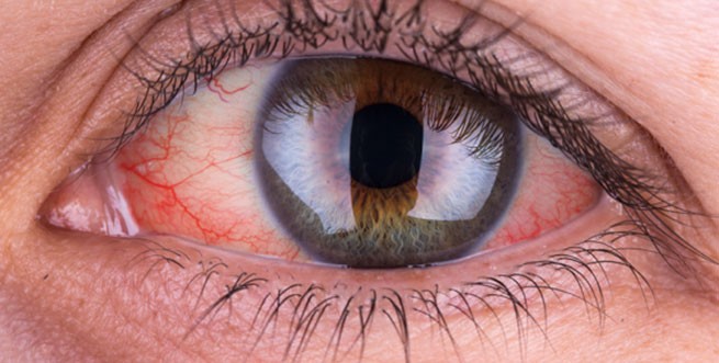 Красные глаза: узнайте о 15 наиболее распространенных причинах